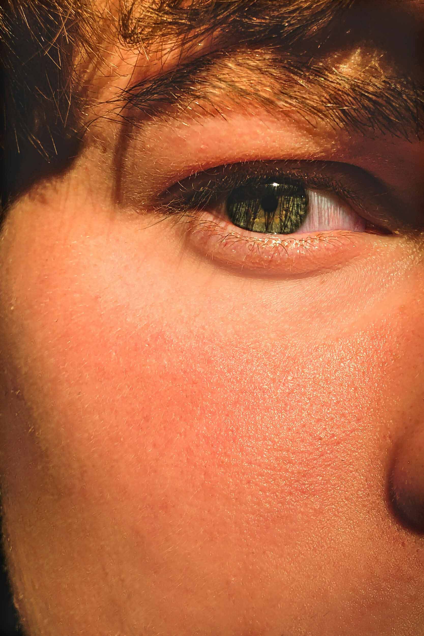 REDNESS & ROSACEA