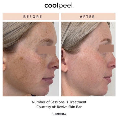 Before and after Deka CO2