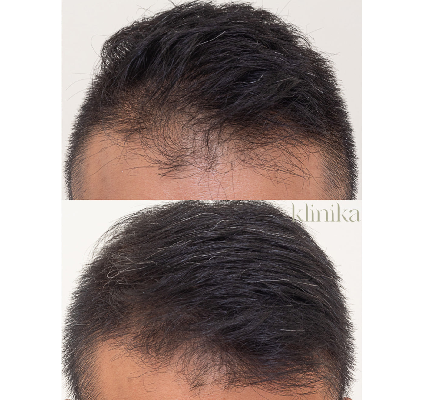 HAIR RESTORATION PROTOCOL (HRP) - Klinika Erina