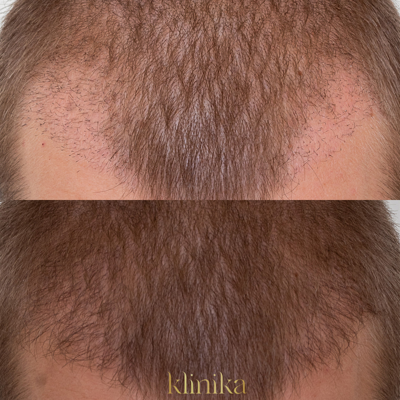 HAIR RESTORATION PROTOCOL (HRP) - Klinika Erina