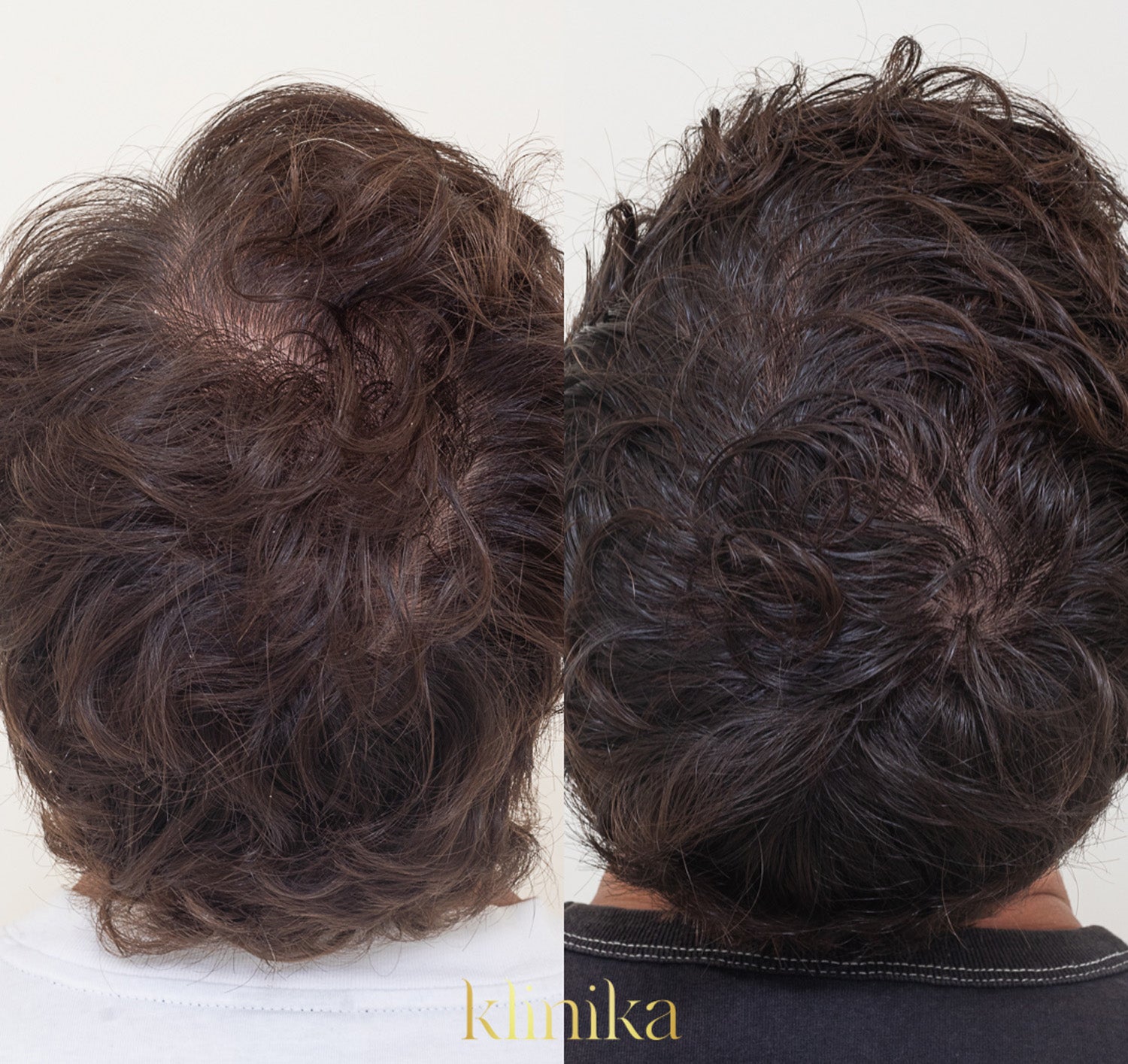 HAIR RESTORATION PROTOCOL (HRP) - after only six sessions - Klinika Erina