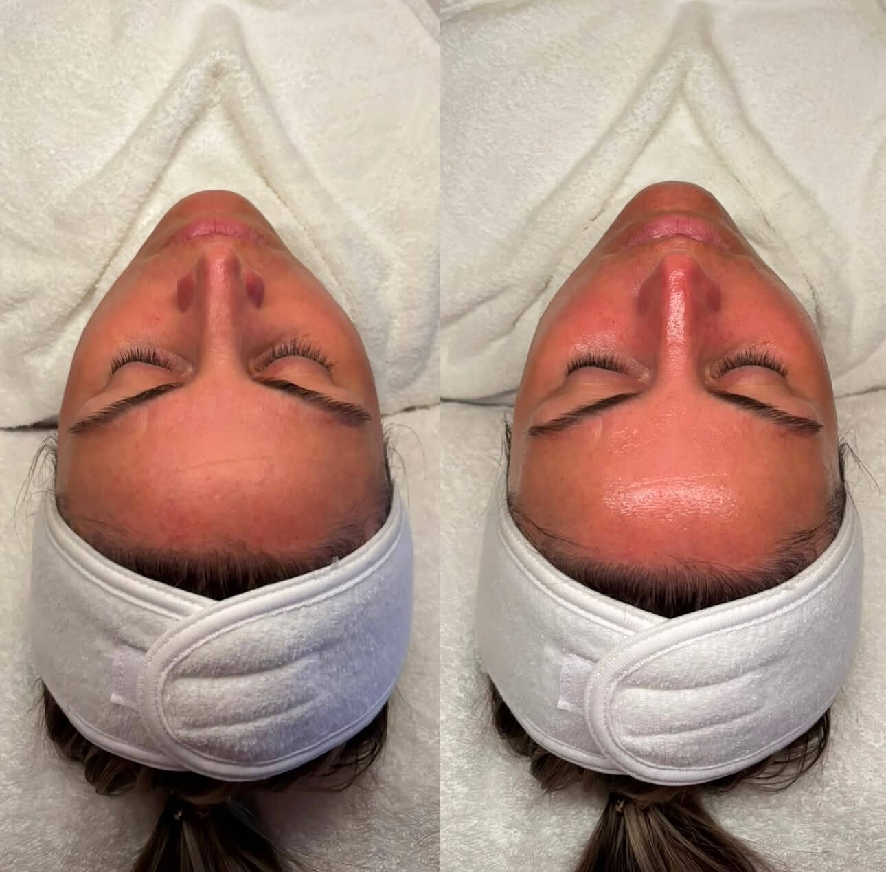 Hydrafacial - Before and After