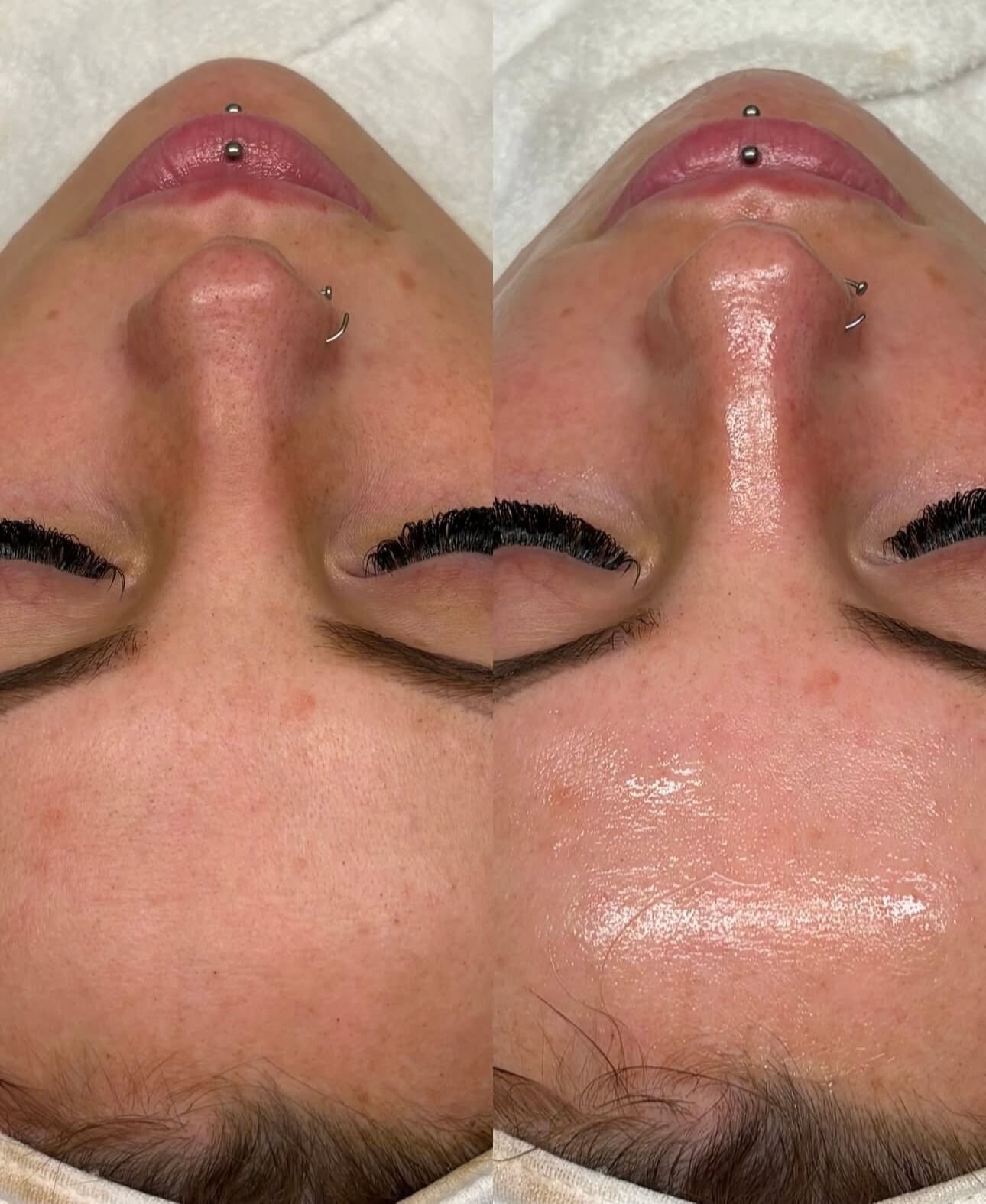 Hydrafacial - Before and After