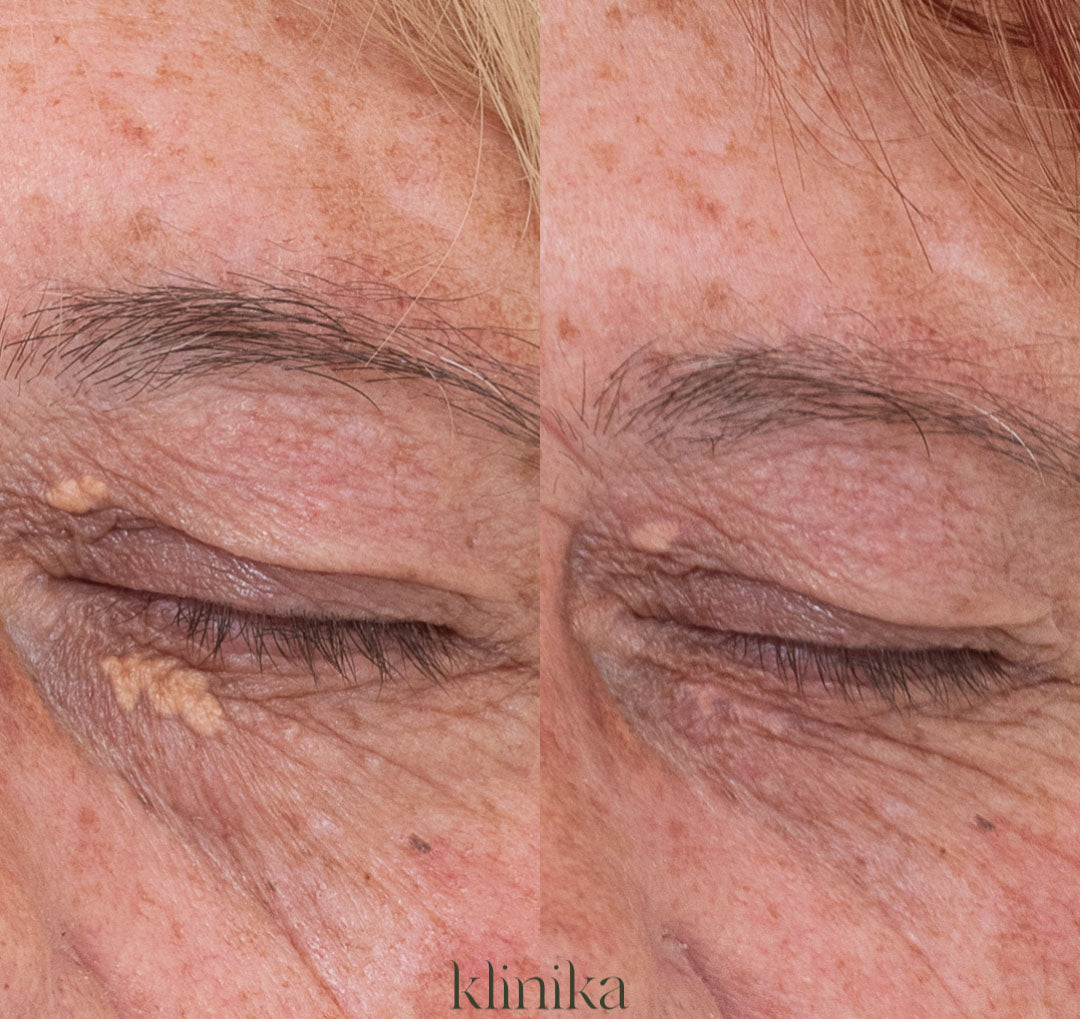 Deka CO2 Before and After