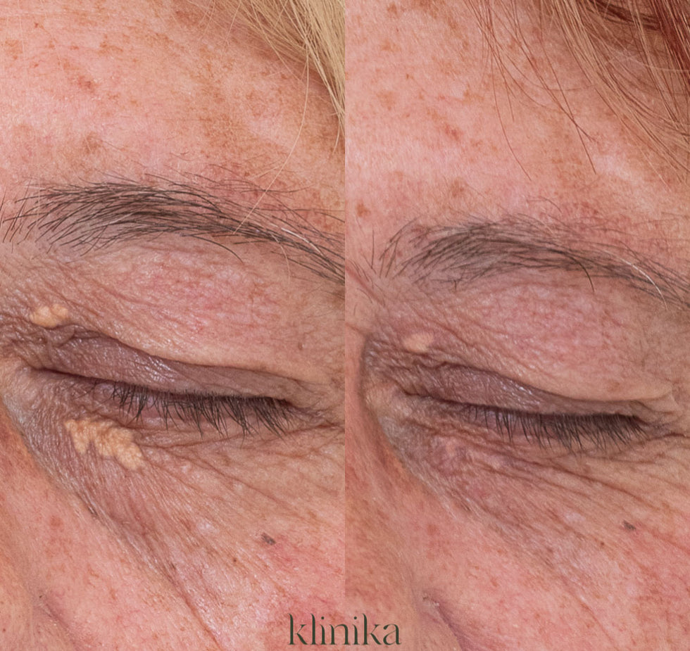 Deka CO2 Before and After