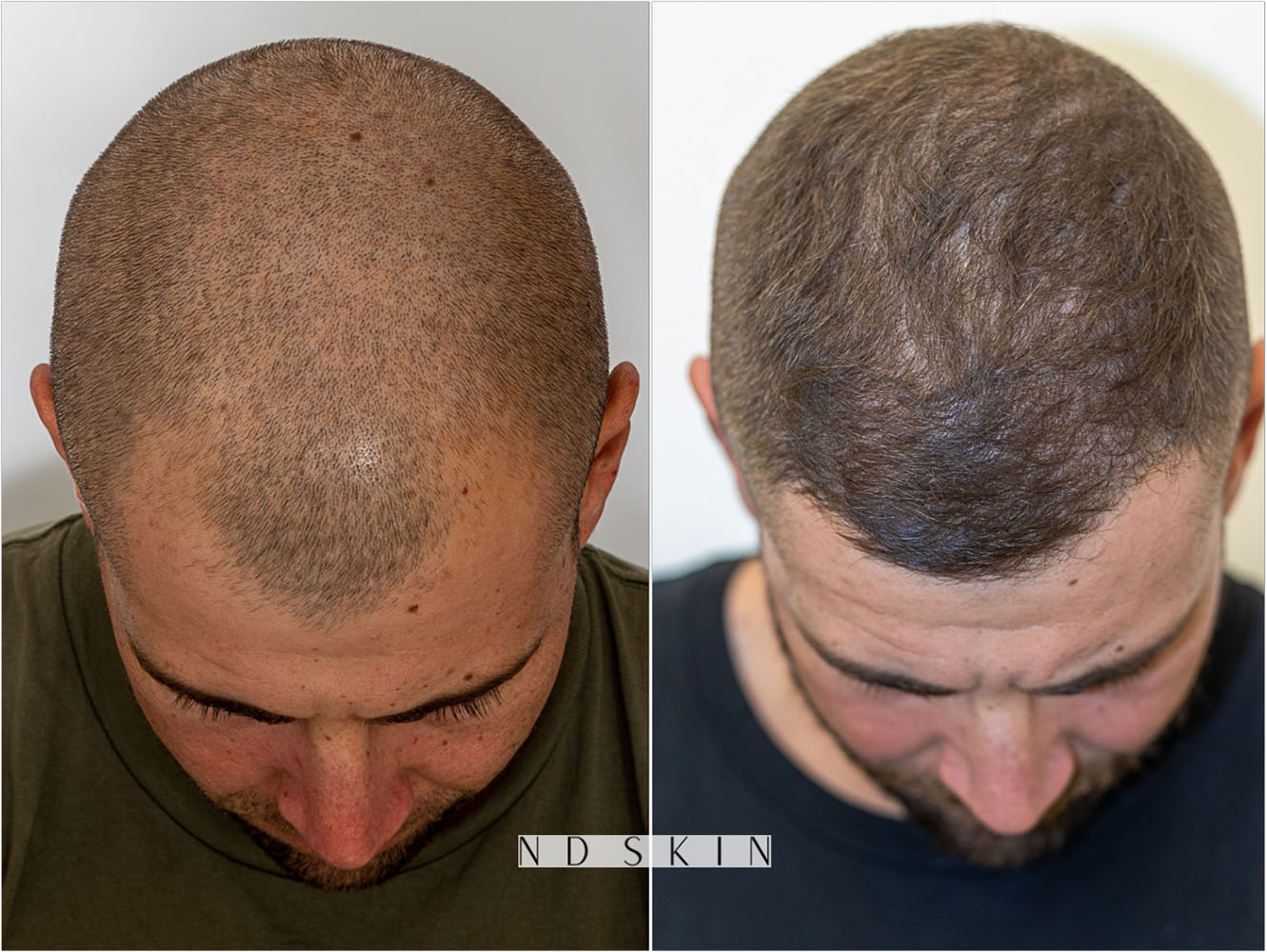 FUE Neograft Hair Transplant