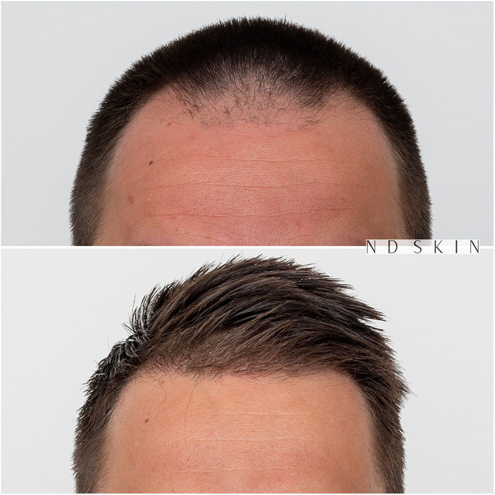 FUE Neograft Hair Transplant