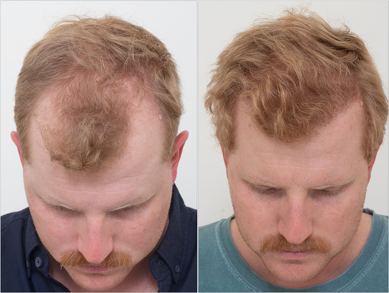 FUE Neograft Hair Transplant