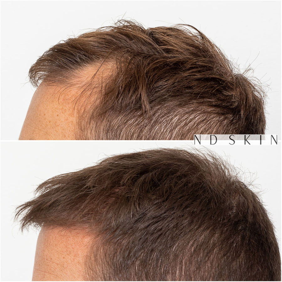 FUE Neograft Hair Transplant